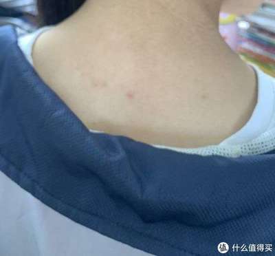 身上长包包很痒怎么办