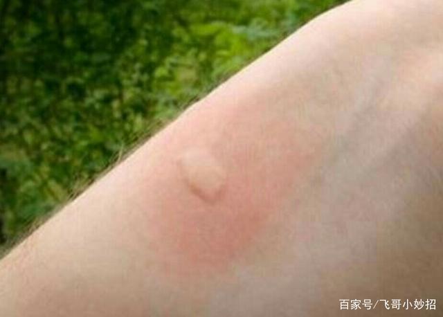 孩子身上长包包很痒怎么办 经常身上起包痒什么原因