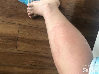 身上长包包很痒怎么办