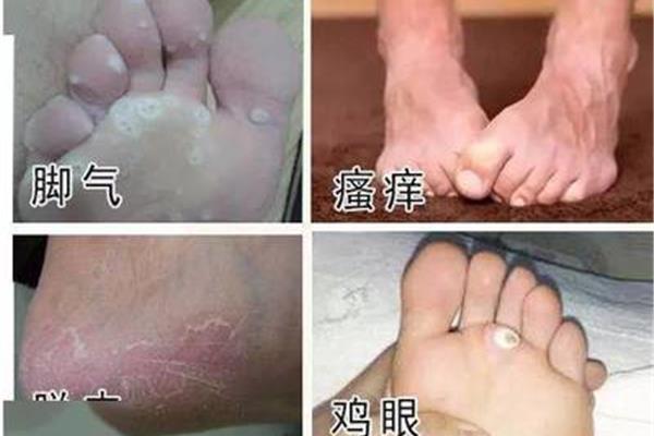 怎么给鞋子去味 如何彻底去除鞋子里的臭味?